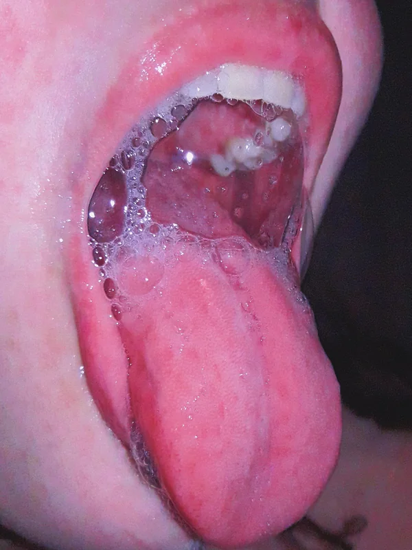 mouthkink
